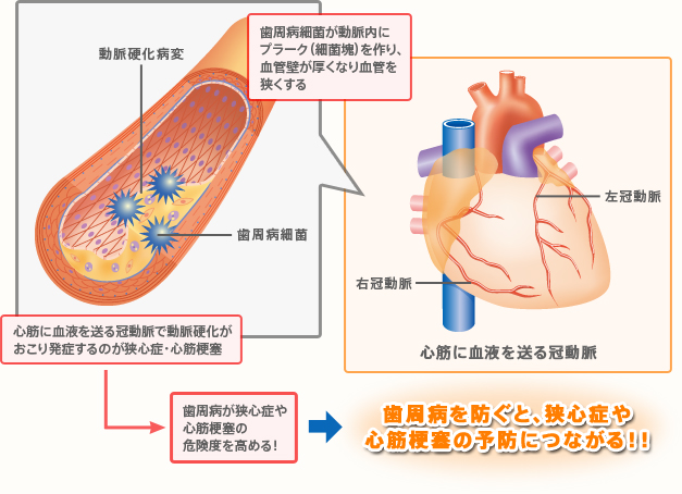 ~歯周病が動脈硬化を促進すると考えられています~